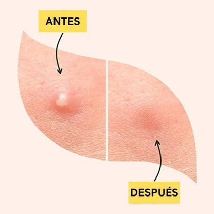 Stickers para acne mis cosmétics